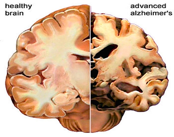Alzheimer Brain - © nutritionreview.org