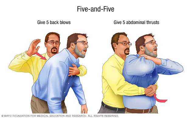 Save from choking - © Mayo Foundation