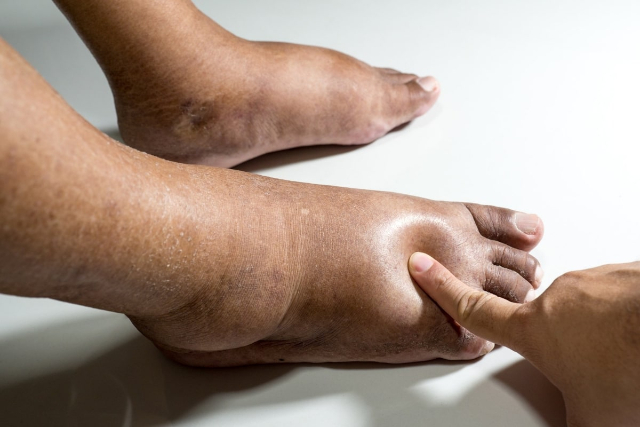 Edema Feet - © 2024 - vohrawoundcare.com
