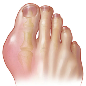 Gout - © 2024 Mayo Foundation