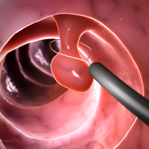 Colon Polyp - © 2026 pennstatehealthnews.org