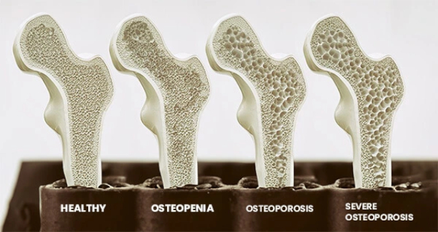 Osteoporosis - © 2024 auroramedicalcentre.com.au